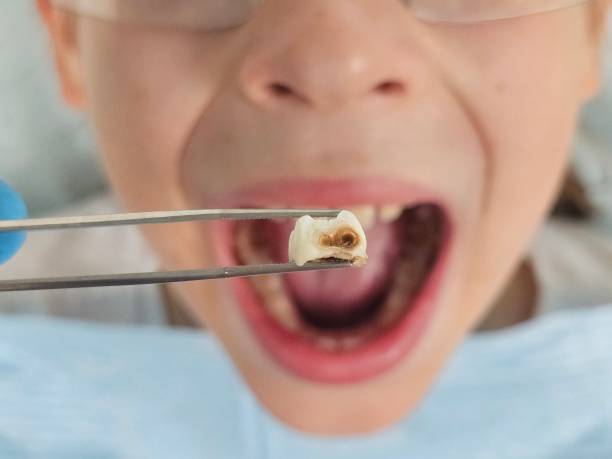 Best Dental Abscess Treatment in Richfield, UT